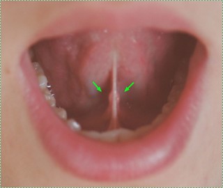 sublingual duct